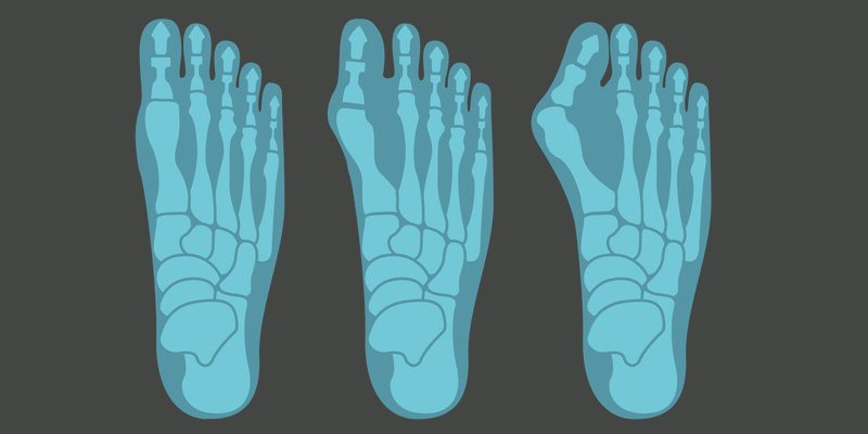 Alles wissenswerte runde um Hallux Valgus Alles wissenswerte runde um Hallux Valgus