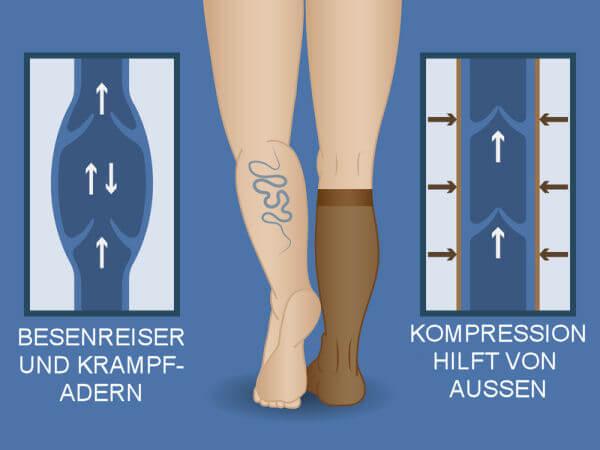 Besenreiser mit Kompression behandeln