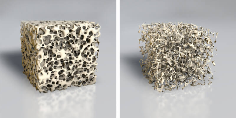 Knochenstruktur bei Osteoporose