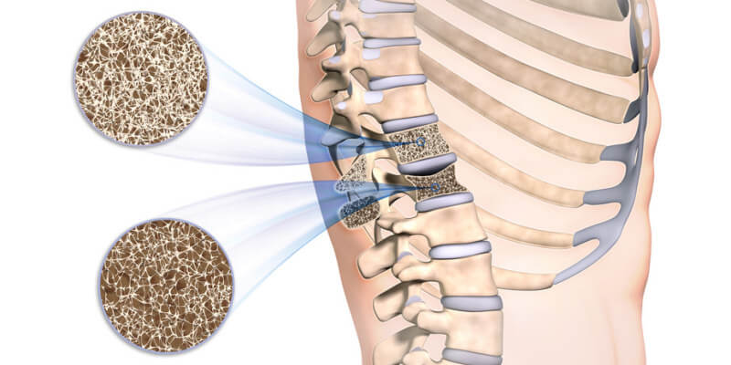 Osteoporose Bestimmung der Knochendichte Rückenwirbel