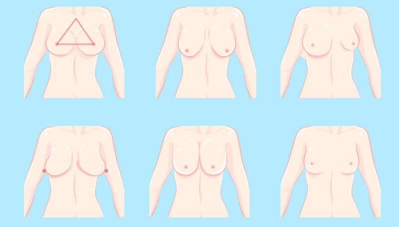 verschiedene Formen der weiblichen Brust