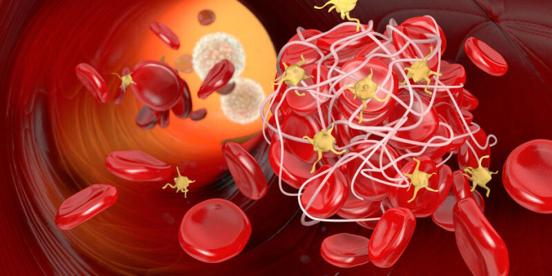 Blutgerinnsel Thrombose im Venensystem