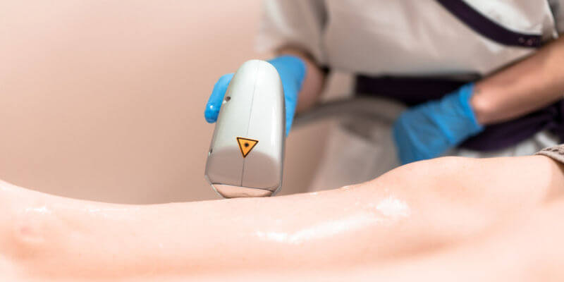 Professionelle Laserbehandlung der Krampfadern