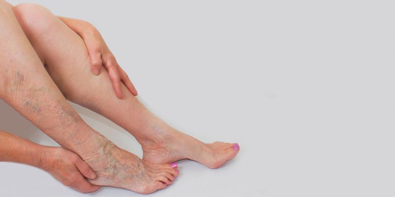 Venenleiden mit vielen Facetten - Krampfadern