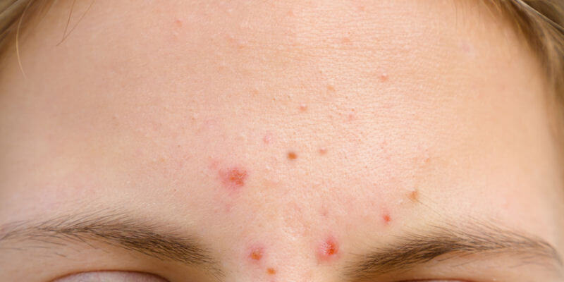 erkrankungsbedingte Pickel und Mitesser