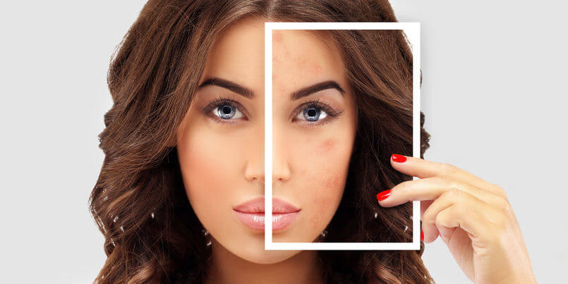 gutes Ergebnis der Mikrodermabrasion bei Akne