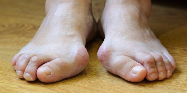 verschiedene Behandlungsmoeglichkeiten fuer Hallux Valgus