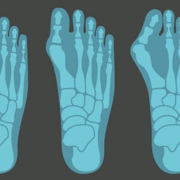 Alles wissenswerte runde um Hallux Valgus