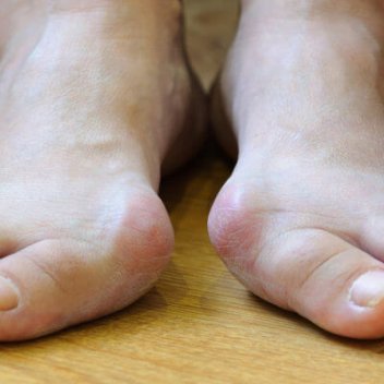 verschiedene Behandlungsmoeglichkeiten fuer Hallux Valgus